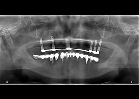 proimages/case/Artificial_implant/HON01.jpg