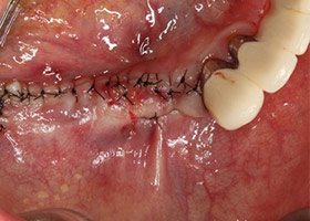 proimages/case/Artificial_implant/HON04-1.jpg