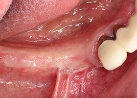proimages/case/Artificial_implant/HON05-1.jpg