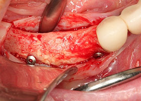 proimages/case/Artificial_implant/HON05-2.jpg