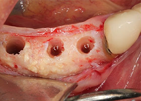 proimages/case/Artificial_implant/HON06-1.jpg