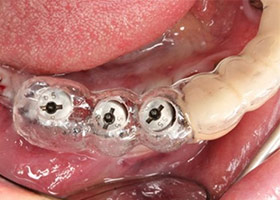 proimages/case/Artificial_implant/HON06-2.jpg