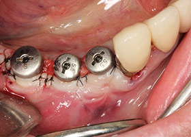 proimages/case/Artificial_implant/HON07-1.jpg