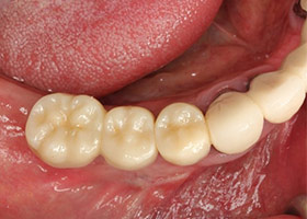 proimages/case/Artificial_implant/HON08-1.jpg