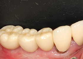 proimages/case/Artificial_implant/HON08-2.jpg
