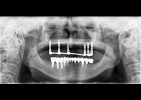 proimages/case/Artificial_implant/HON09.jpg