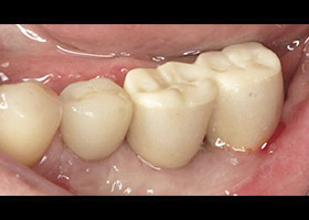 角質化牙齦增生手術 