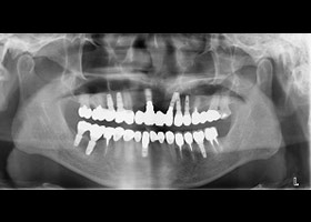 proimages/case/Artificial_implant/after01.jpg
