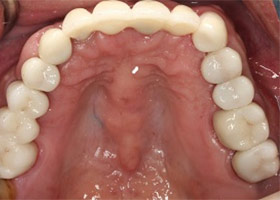 proimages/case/Artificial_implant/after03.jpg