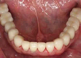 proimages/case/Artificial_implant/after04.jpg