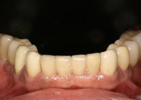 proimages/case/Artificial_implant/all-4.jpg