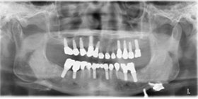 proimages/case/Artificial_implant/all-5.jpg