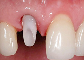 proimages/case/Artificial_implant/be-3.jpg