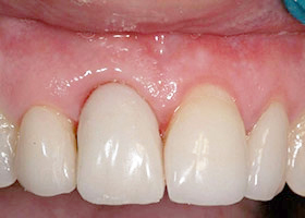 proimages/case/Artificial_implant/be-4.jpg