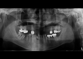 proimages/case/Artificial_implant/before01.jpg