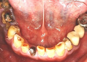proimages/case/Artificial_implant/before03.jpg