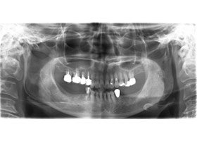 proimages/case/Artificial_implant/bite01.jpg proimages/case/Artificial_implant/bite01.jpg