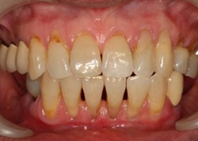 proimages/case/Artificial_implant/bite02.jpg proimages/case/Artificial_implant/bite02.jpg