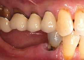 proimages/case/Artificial_implant/bite03.jpg proimages/case/Artificial_implant/bite03.jpg