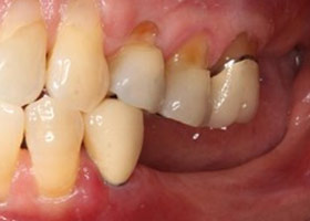 proimages/case/Artificial_implant/bite04.jpg proimages/case/Artificial_implant/bite04.jpg