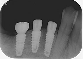 proimages/case/Artificial_implant/bite05.jpg proimages/case/Artificial_implant/bite05.jpg