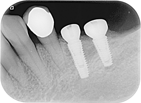 proimages/case/Artificial_implant/bite06.jpg proimages/case/Artificial_implant/bite06.jpg