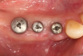proimages/case/Artificial_implant/bite07.jpg proimages/case/Artificial_implant/bite07.jpg