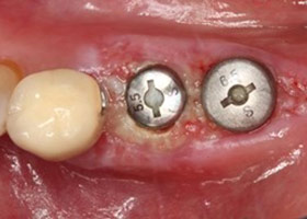 proimages/case/Artificial_implant/bite08.jpg proimages/case/Artificial_implant/bite08.jpg