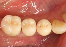proimages/case/Artificial_implant/bite09.jpg proimages/case/Artificial_implant/bite09.jpg