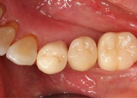 proimages/case/Artificial_implant/bite10.jpg proimages/case/Artificial_implant/bite10.jpg
