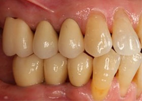proimages/case/Artificial_implant/bite11.jpg proimages/case/Artificial_implant/bite11.jpg
