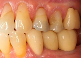 proimages/case/Artificial_implant/bite12.jpg proimages/case/Artificial_implant/bite12.jpg