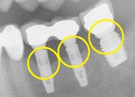 proimages/case/Artificial_implant/save-defeat01-1.jpg