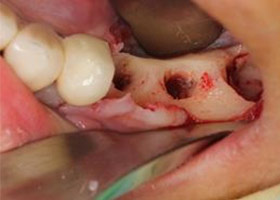 proimages/case/Artificial_implant/save-defeat02-2.jpg