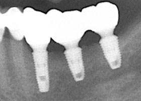 proimages/case/Artificial_implant/save-defeat05-1.jpg