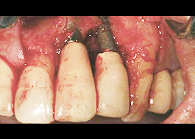 proimages/case/Artificial_implant/save1-1.jpg