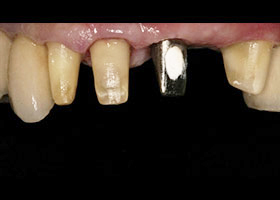proimages/case/Artificial_implant/save2-1.jpg