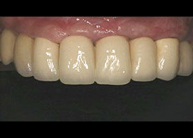 proimages/case/Artificial_implant/save2-2.jpg