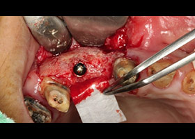 proimages/case/Artificial_implant/serious5.jpg