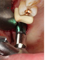 proimages/case/Artificial_implant/topcase03.jpg