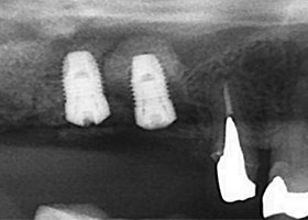 proimages/case/Artificial_implant/topcase04.jpg