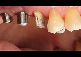 proimages/case/Artificial_implant/topcase05.jpg