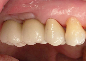 proimages/case/Artificial_implant/topcase06.jpg
