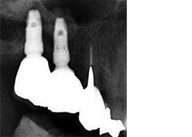 proimages/case/Artificial_implant/topcase07.jpg