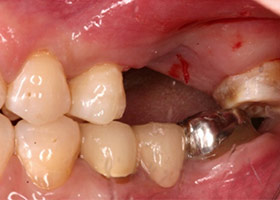 proimages/case/Artificial_implant/tr-1.jpg