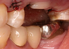 proimages/case/Artificial_implant/tr-3.jpg
