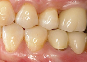 proimages/case/Artificial_implant/tr-4.jpg