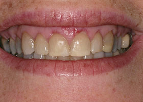 proimages/case/Beauty_Dentistry/beautyteeth-02-1.jpg