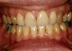 proimages/case/Beauty_Dentistry/white01.jpg proimages/case/Beauty_Dentistry/white01.jpg