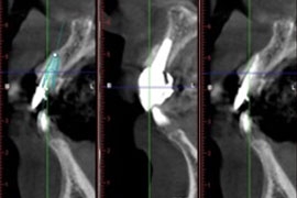 立即植牙及3D立體斷層掃描